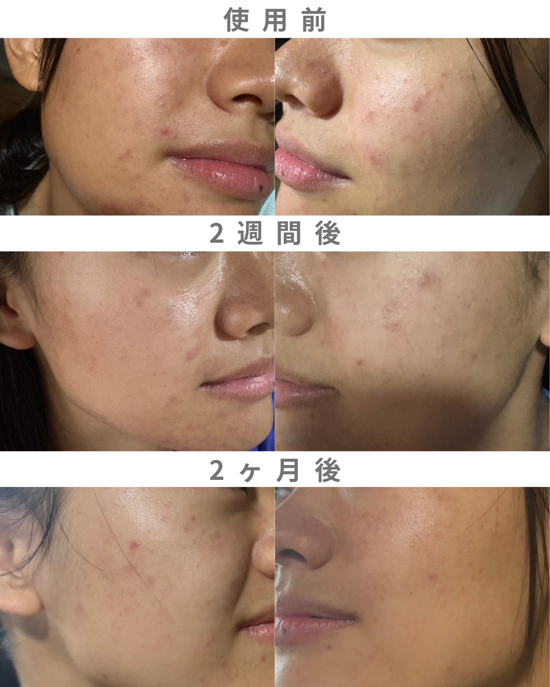 善玉菌 腸活 善玉菌 美肌菌 ニキビ改善 人気スタイリスト　ランキングが高い美容院　白髪染め　ハゲ予防　美革ストレート　岐阜柳津町　ヘアーラウル